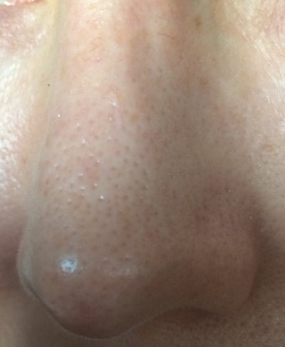 Dark Red Patch On Nose