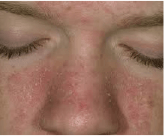 Dark Red Patch On Nose